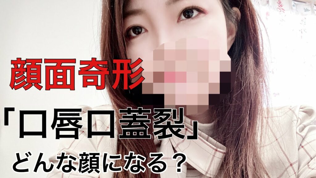 高 木星 来 ダウン症-【閲覧注意】顔面奇形 口唇口蓋裂 大人になったらどんな顔になる? 手術後 傷 cleftlip and plate